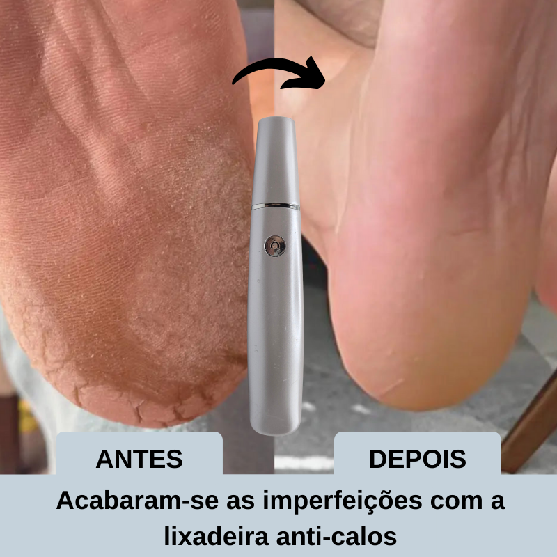 Lixadeira anti-calo